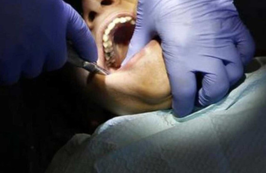 Çocuğun ağzında 526 diş bulundu tıp dünyasını şoke eden olay!