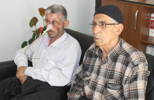 Ağrıyan dişini çektirdi yüzünün yarısı çöktü bir gözü kayboldu