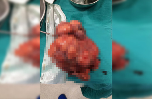 Manisa'da bir kadının karnından 2 kilogram ur çıktı