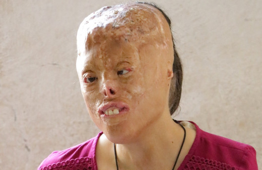 Başörtüsü yanınca bu hale geldi! Çocuklar korkuyor diye okula almıyorlar