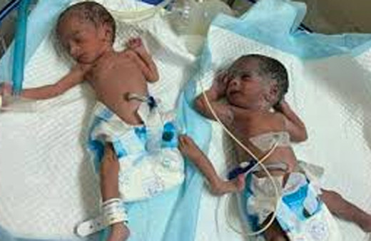 Tıp dünyası için ilginç olay! Hindistanlı kadın 73 yaşında ikiz doğurdu