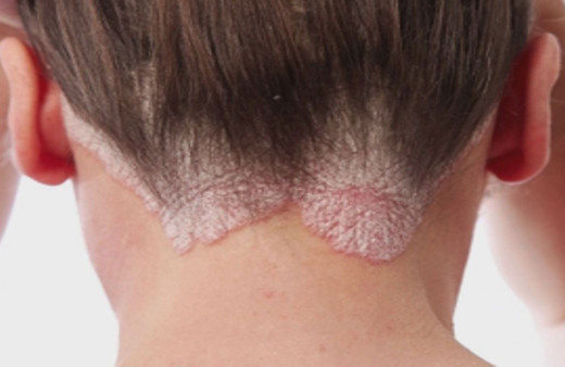 Uzmanı uyardı! Mevsim geçişlerinde alerjik egzamaya dikkat...Nelere dikkat edilmeli