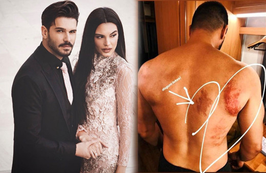 Şampiyon'un yıldızı Tolgahan Sayışman'da morlukları gören Almeda Abazi isyan etti