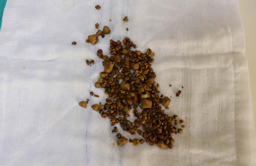 Manisa'da karın ağrısı şikayetiyle gitti! Safra kesesinden 400 taş çıkarıldı