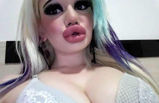 15 ameliyat geçirdi dudakları öyle bir hale geldi ki evlilik teklifi yağıyor