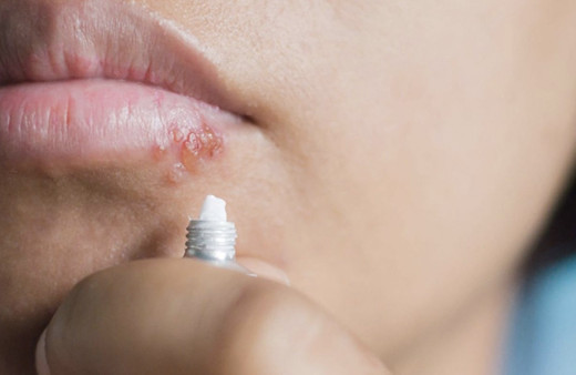 Uçuk neden çıkar uçuk nasıl tedavi edilir evde tedavisi