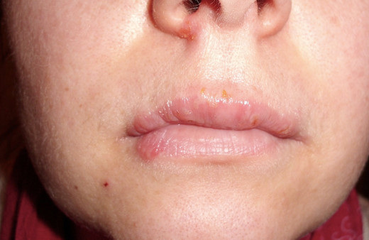 Dudakta çıkan uçuk nasıl geçer evde uçuk tedavisi