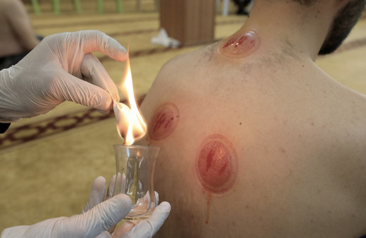 Kasım ayı hacamat günleri ne zaman yaptırılır hacamat takvimi