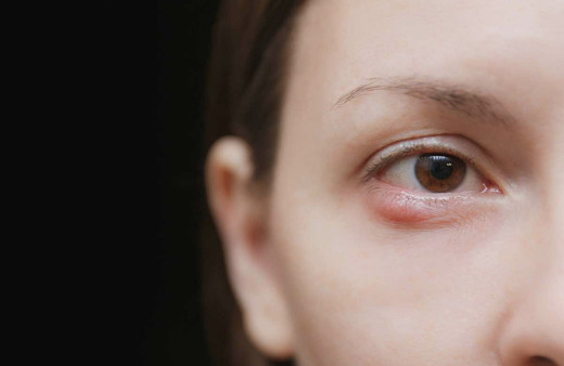 Gözde arpacık neden çıkar nasıl geçer evde tedavisi var mı?