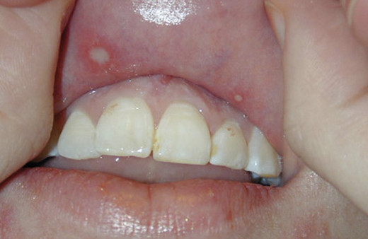 Ağız yarası Aft neden olur ilaç çare değil afta ne iyi gelir