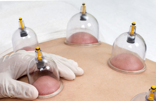 Hacamat nedir! Kimlere yapılır faydalı mıdır?