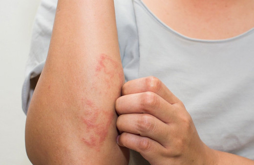 Strese bağlı deri döküntüsü nasıl geçer?