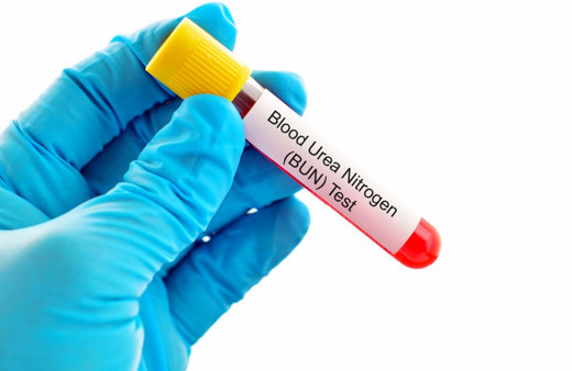 Bun testi nedir? Düşük ve yüksek BUN değeri kaç normalde ne olmalı?