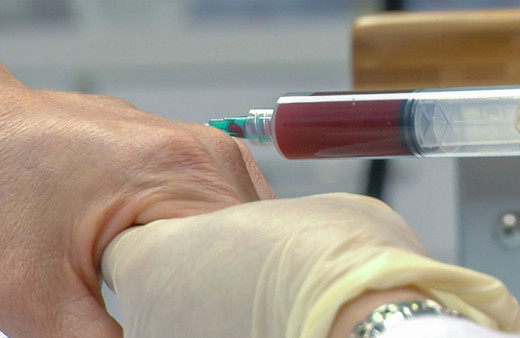 PRP tedavisi nedir? Saç, cilt ve kireçlenme için PRP kaç seans yapılır