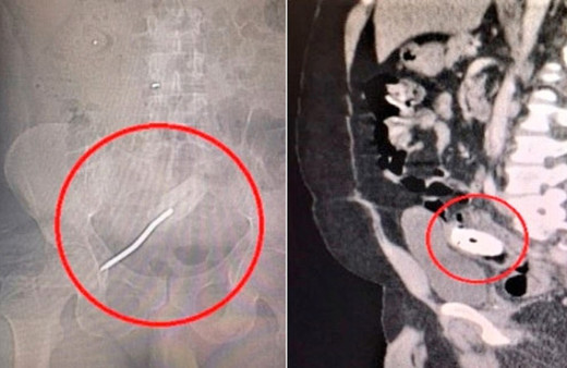 Anüsüne sokunca bir anda içeri kaçtı 1 hafta sonra da...