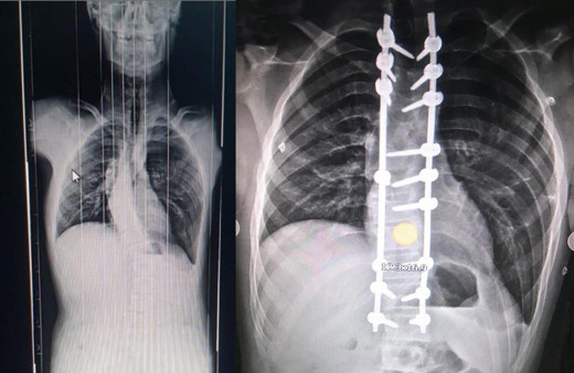 Skolyoz hastalığı ihmale gelmiyor! Çocuklarda bu yaşa dikkat