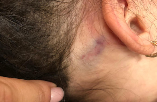 İzmir'de 2,5 yaşındaki kız çocuğu anaokulunda yaşıtları tarafından dövüldü