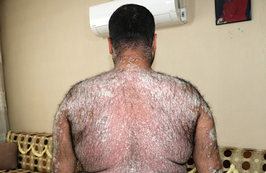 Hastalığı ilerledi kimse korkmasın diye sokağa çıkmıyor