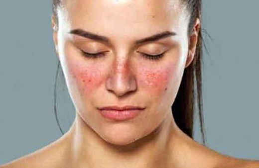 Lupus nedir ciltte döküntülere sebep oluyor!