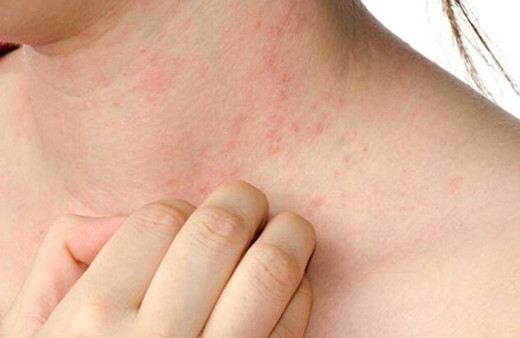 Uyuz hastalığının belirtileri ve nedenleri kıyafet denerken dikkat!