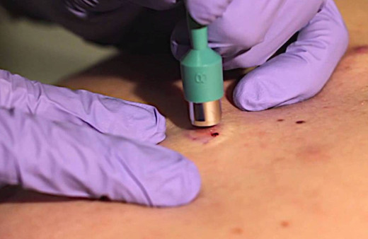 Kapsül robotlar biyopsi yapacak