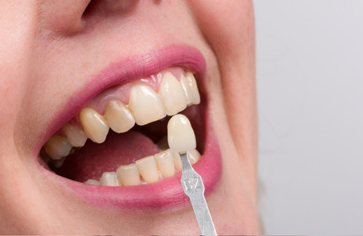 Dişim renk değiştirdi fırçalıyorum ama düzelmiyor diyorsanız...