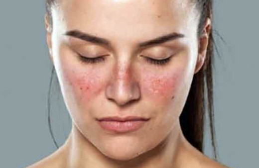 Lupus nedir Lupus hastalığı belirtileri neler tedavisi mümkün mü?