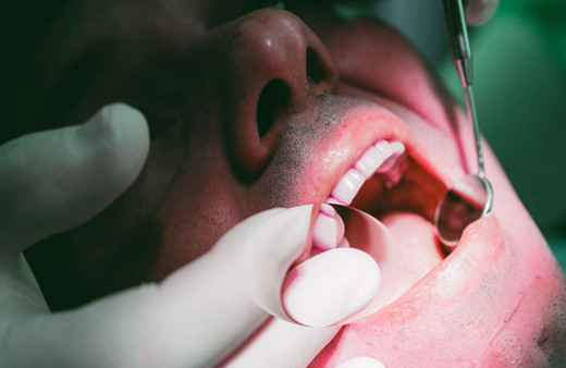 Sinsi şekilde ilerleyen ağız kanseri erkeklerde iki kat daha fazla görülüyor!