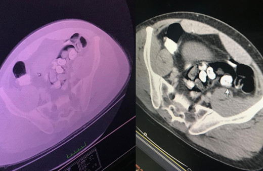İranlının midesinden çıkan uyuşturucular şaşkınlık yarattı ne ararsan var