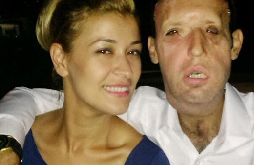 Yüz nakilli Recep Sert'ten kötü haber! Eşi Esma Sert açıkladı