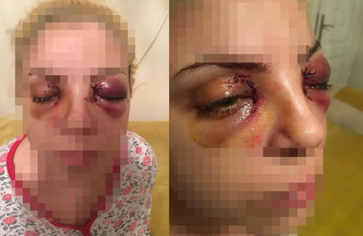 Hastanede oda arkadaşı gözlerini oymaya çalıştı! Burcu saldırıyı anlattı