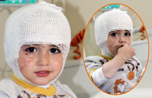 Başından aşağı kaynar çay dökülen minik Hüyesin yandı