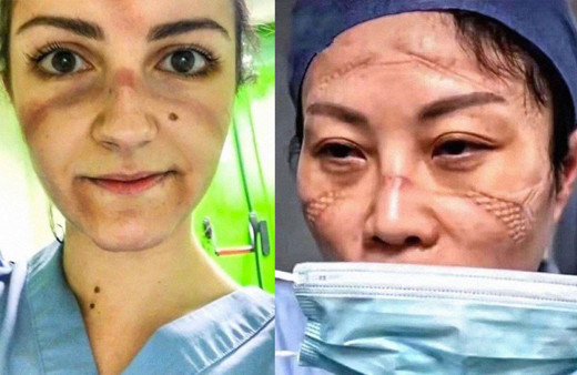 Koronaveirüsle savaşın kahramanları bunlar da kahramanlık izleri