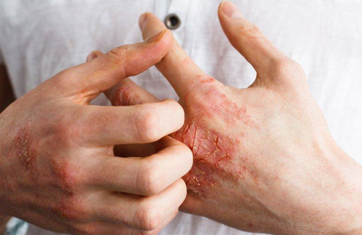 Fazla kolonya kullanımı egzamaya neden oluyor!