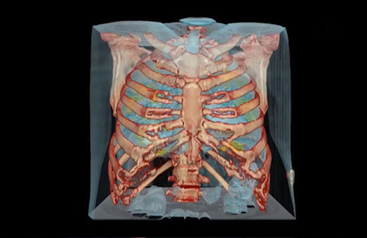 Koronavirüs bulunan akciğerin 3D görüntüsü yayımlandı