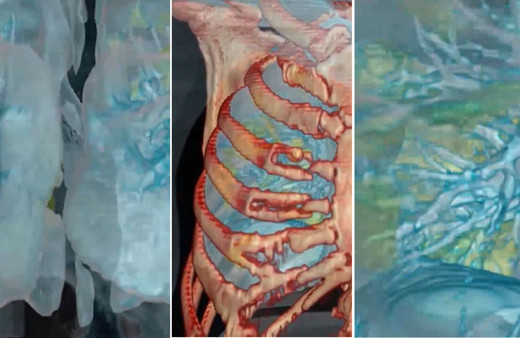 Koronavirüs bulunan akciğerin 3D görüntüsü korkuttu