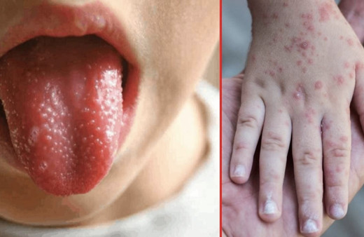 Kawasaki sendromu nedir Kawasaki tanı teknikleri neler?