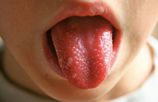 Kawasaki sendromu hastalığı belirtileri neler ateşe dikkat!