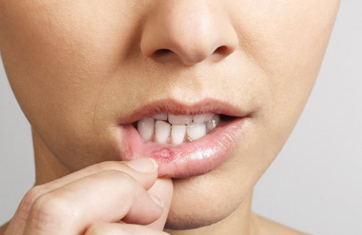 Aft nedir yemek yemeyi zorlaştırıyor sumak iyileştirir mi?