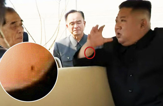 Kuzey Kore lideri Kim Joung-un'un kolundaki izler ne? Yakın dostu herşeyi açıkladı