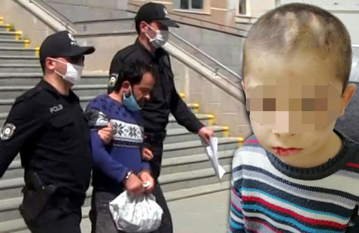Üvey baba dehşeti! Çocuğa işkence edip üzerinde sigara söndürmüş