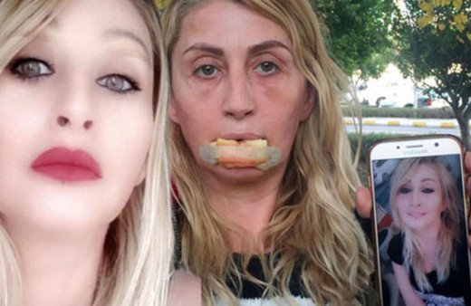 4 kez dolgu yaptırdığı alt dudağı koptu! Şimdi yeniden yaptırıyor