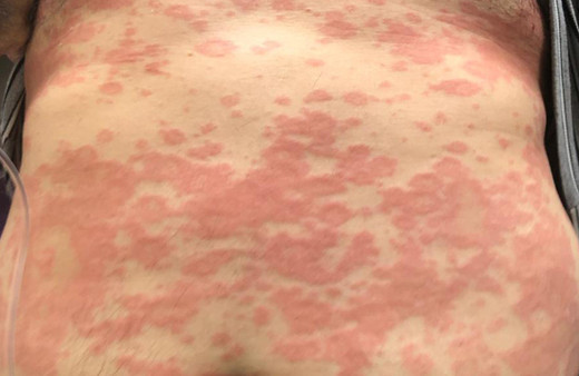 Cerrahpaşa'da çekildi! Derideki kızarıklık, kurdeşen ve kaşıntı koronavirüs belirtisi mi?