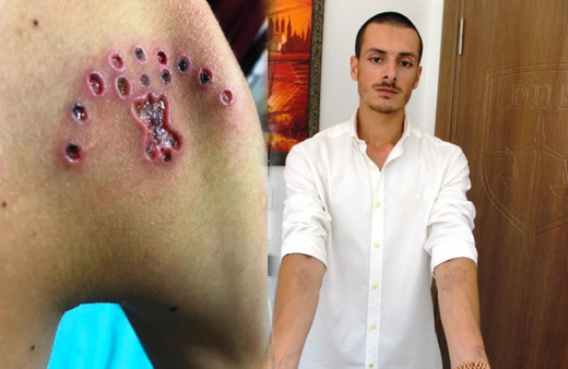 Bodrum'da asker olmak için dövmelerini sildiren genç hayatının şokunu yaşadı