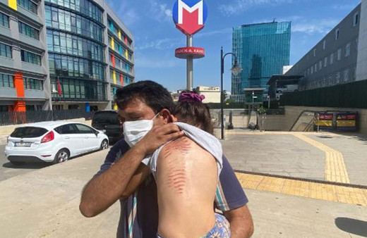 Metroda saçları merdivene sıkışmıştı! İşte Berfin'in son durumu