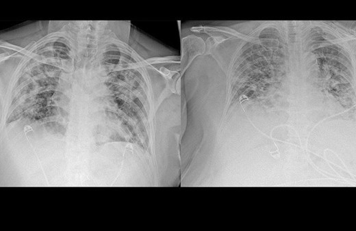 Koronavirüsün akciğerdeki ağır tahribatı hastaların tomografi görüntülerine yansıdı