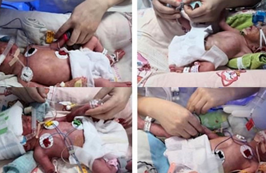 70 milyonda bir ihtimal gerçekleşti! 3 kez düşük yaptı ardından dördüz doğurdu