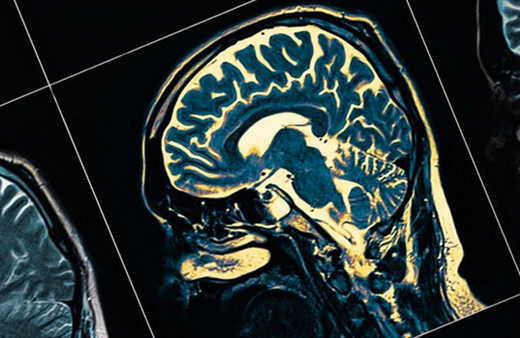 Çığır açacak gelişme! Bilim insanları Alzheimer'ın tedavisini buldu