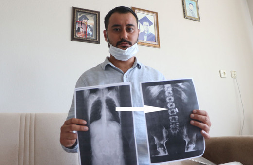 15 Temmuz gazisi 4 yıldır vücudunda hainlerin sıktığı mermiyle yaşıyor