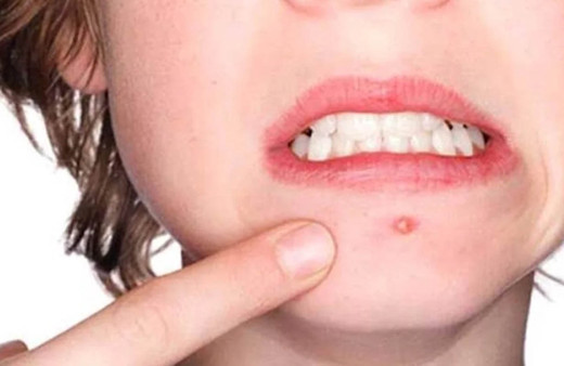 Uzmanlar uyardı! Ölüm üçgeni'nde çıkan sivilcelere dikkat